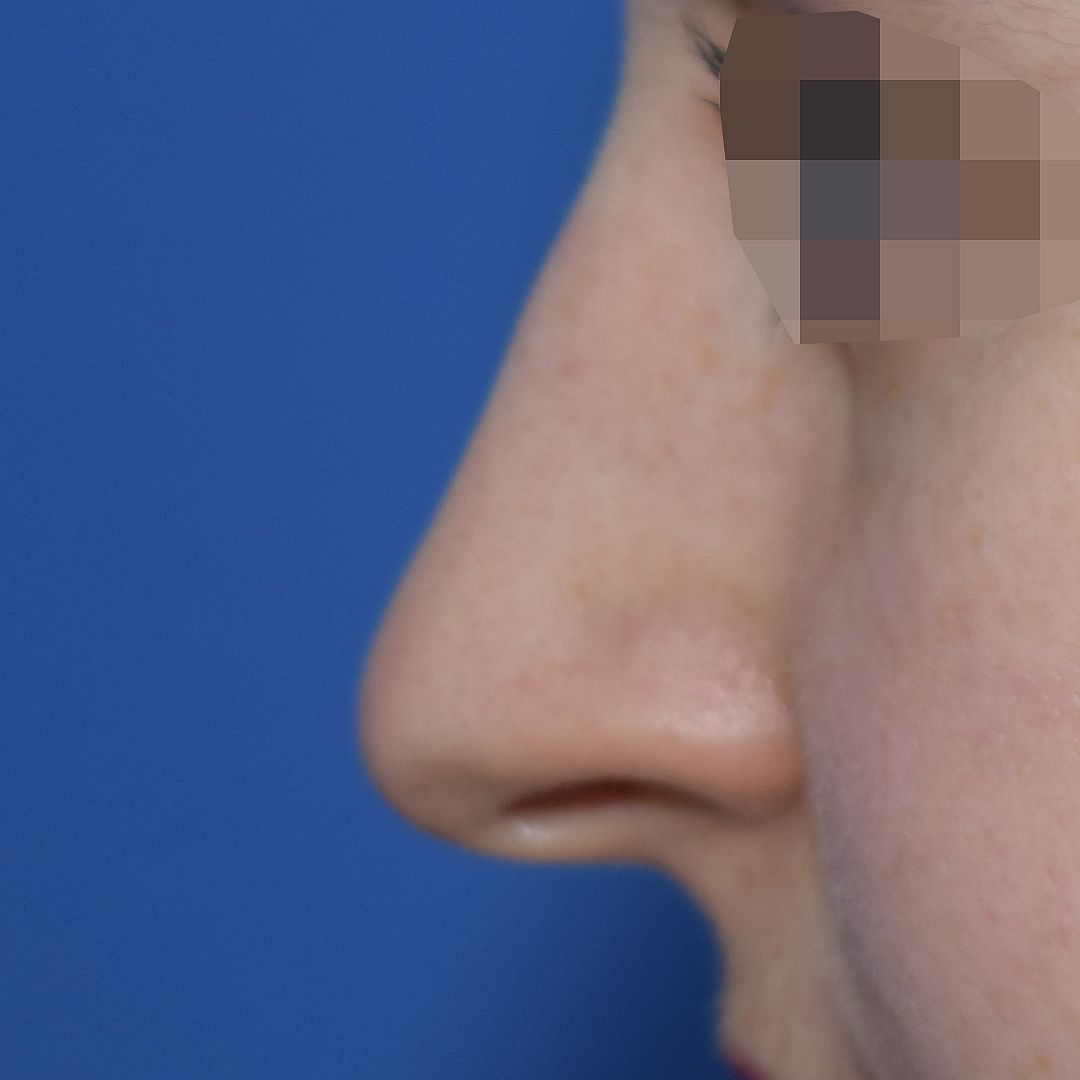 Nasenkorrektur, 20 Vorher Nachher