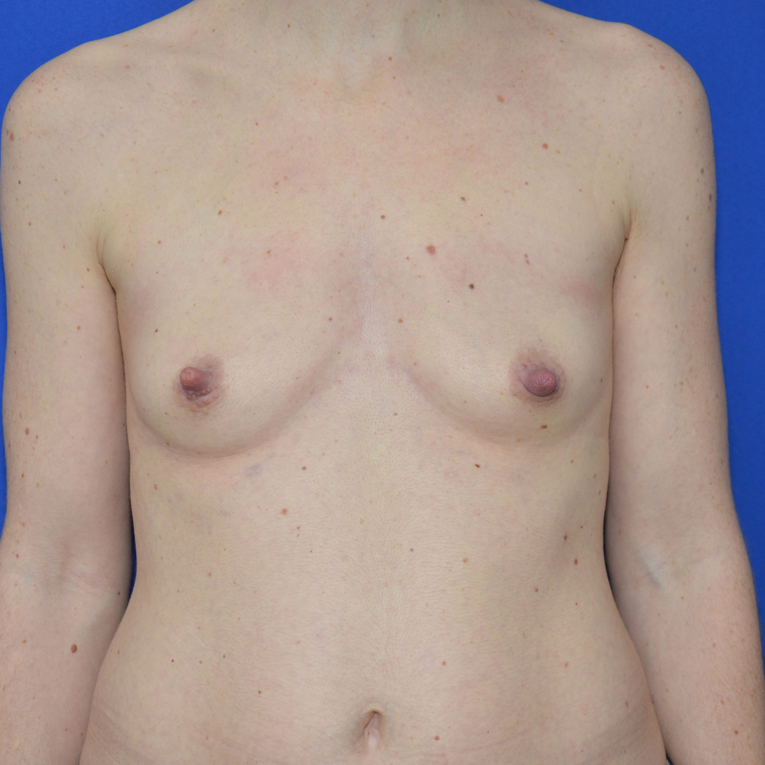 Bruststraffung mit Implantat, 39 Vorher Nachher