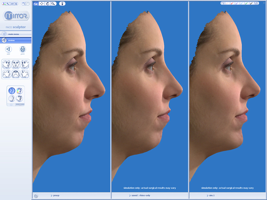 3D Simulation einer Nasenkorrektur 3D Simulation einer Nasenkorrektur