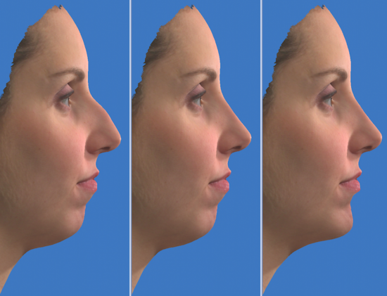 3D Simulation einer Nasenkorrektur