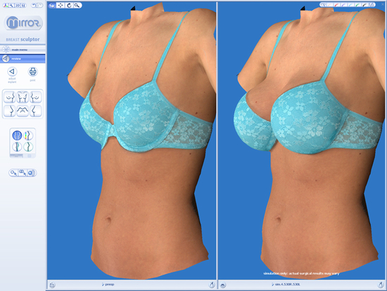 3D Simulation einer Brustvergrößerung 3D Simulation einer Brustvergrößerung