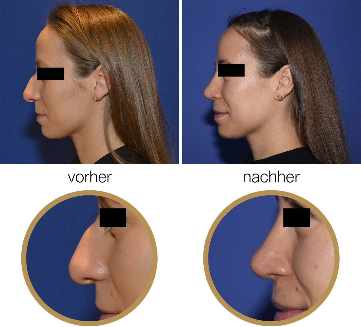 Nasenkorrektur Vorher-Nachher: Korrektur eines Nasenhöckers